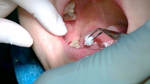 Sau khi nhổ răng bệnh nhân được cho cắn gạc cầm máu