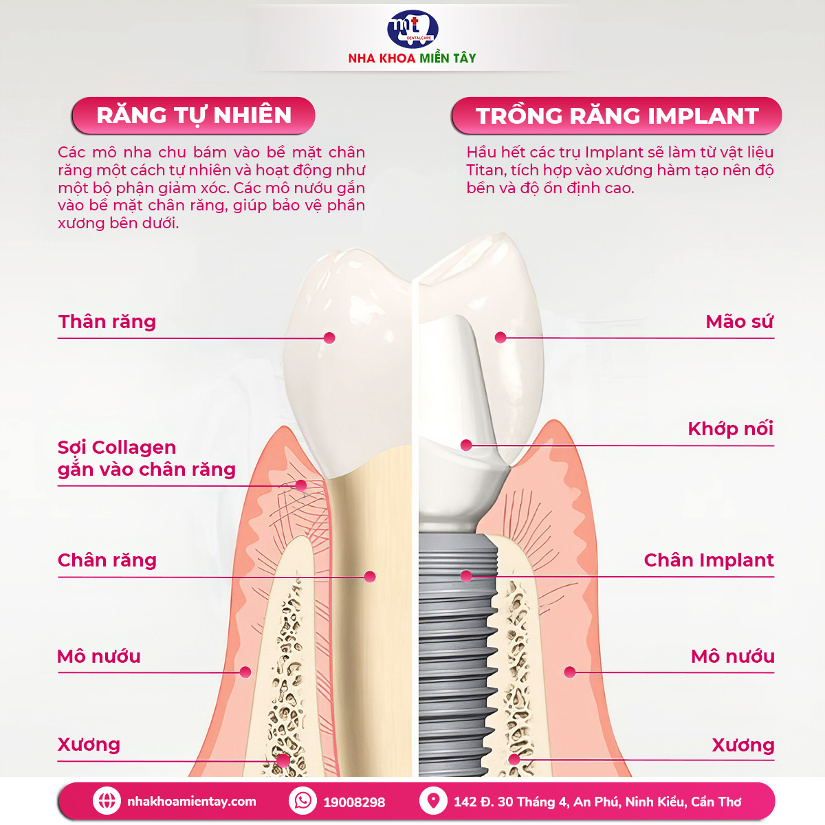 Cấu tạo răng implant