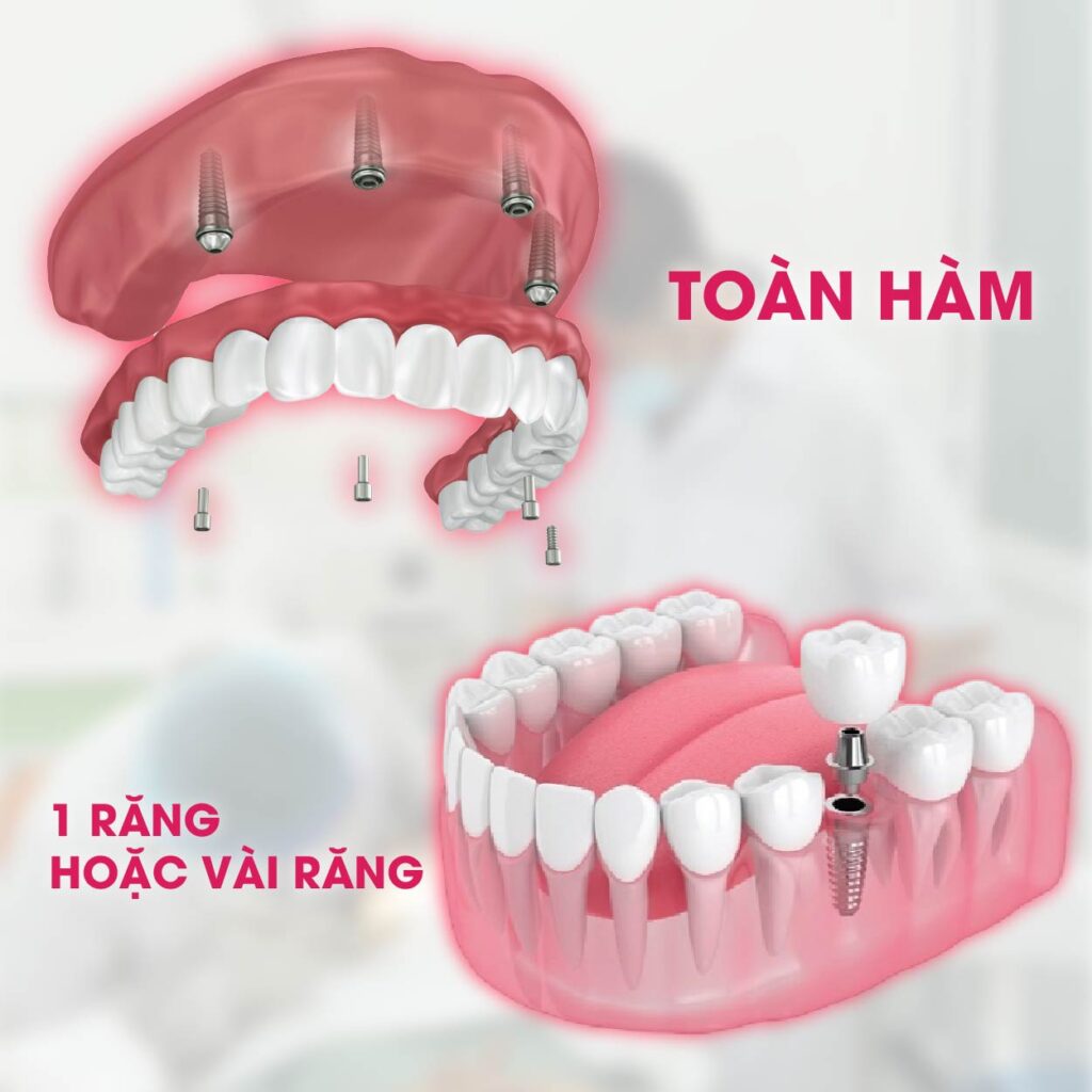 Ai nên trồng implant