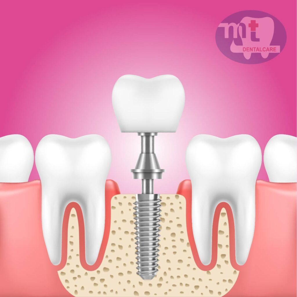 Làm răng implant tuyệt đối an toàn