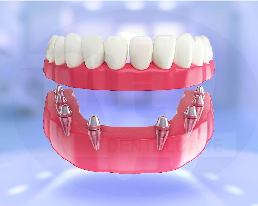 Implant toàn hàm