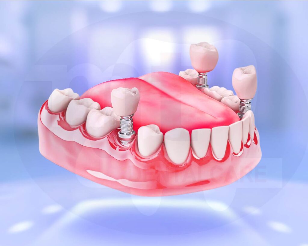 Implant 1 vài răng