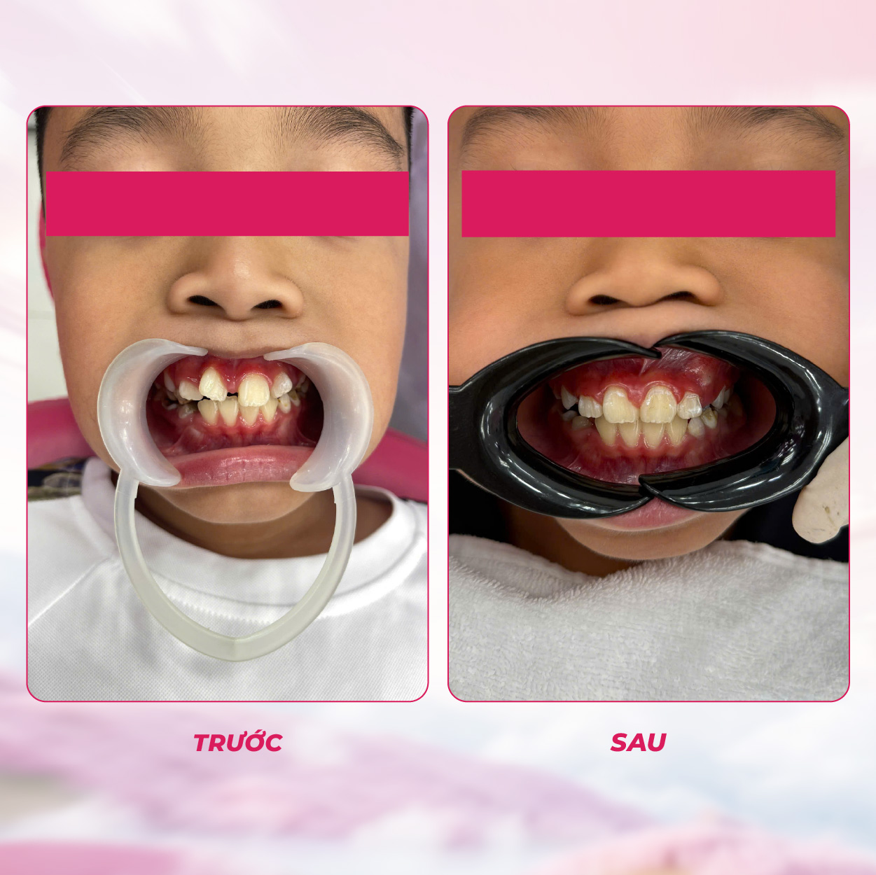 Niềng răng trẻ em - section 3-03