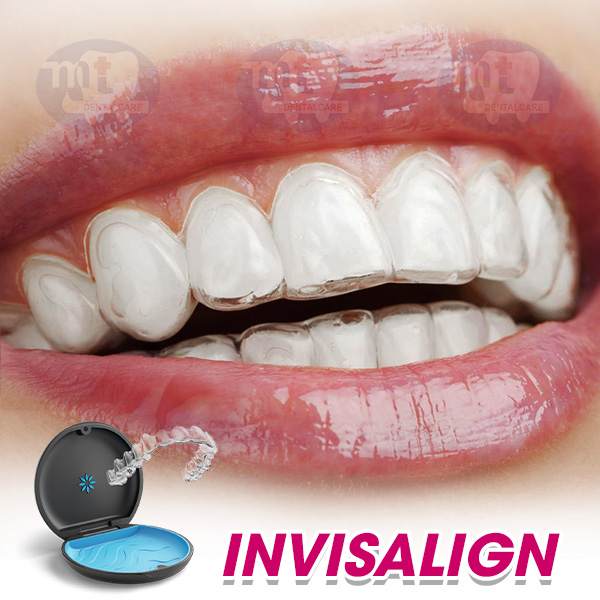 INVISSALIGN