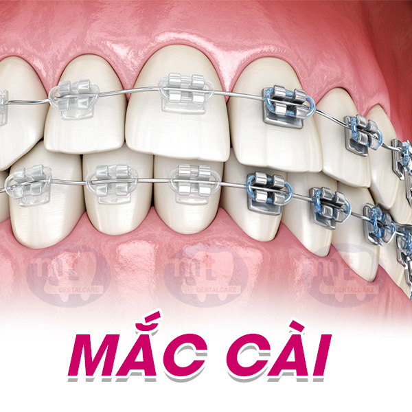 MẮC CÀI